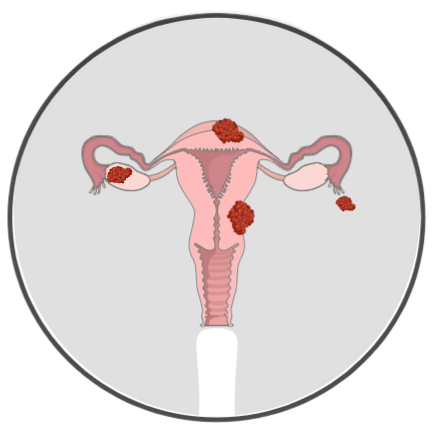 ENDOMETRIOZA